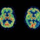 Zap inflammation and reverse Alzheimer’s? zap-inflammation-and-reverse-alzheimers-800x600-73f7422e859cb17cc0e7ce513c4ad9afd9d95e21