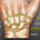 Carpal Tunnel Syndrome Revisited Image2-1-2426959cbca7f11accbceb8ca56e6e95937ae42e