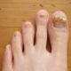 Curing toe Nail Fungus by Herbal Remedies images-1-4a6645fef907dd6967a9fc1df711aced9c61d7b6