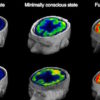 PET Scans Predict Coma Outcome petscans1-55eab78ce3ef0ac88517ddc6a1ee347930cd7997