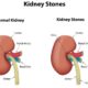 Got Kidney Stones? A Few Roller Coaster Rides Might Help 31812792_l-e1474957192342-14d8c3c82f536ff1a33ca53a810e2ec315083ffd