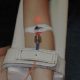 Ultraviolet Blood Treatment Revisited Intravenous_Blood_Irradiation-b3a11b189ef42b677ae4702a5ffcd90a41ed4432