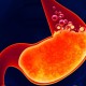 Heartburn Remedies 8_Simple-Home-Remedies-To-Relieve-Acid-Reflux-Naturally-770x402-424cccdbf0b0f62c1fe3d2541da82030a55bc238