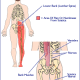 Sciatica – What can I do? sciatica-a067c5f16cf2a2febba5b3a7100c5009ba440e97