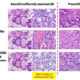 Reclassifying thyroid cancer and the willful misunderstanding of overdiagnosis Thyroid-b93dfbd7359d452c532d47145b1d6191a8992752