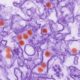 CDC Expands Zika Guidelines zika-virus-300x300-f6e3be2cf0a92ff2276096e4976a0b440040b7e7