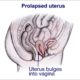 Johnson & Johnson Sued Again over Transvaginal Mesh Marketing prolapseduterus-e1471508105116-86addf8aeff893cc6989ad8aaa0aec4a0fbe138d