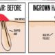 3 Ingredient Oil Recipe to Remove Ingrown Hairs in Minutes 3-Ingredient-Oil-Recipe-to-Remove-Ingrown-Hairs-in-Minutes-63439220e0dbb767f0238cb145b823aa362a2394