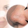 10 Natural Home Remedies to Get Rid of Clogged Pores Fast Get-Rid-of-Clogged-Pores-f31b1dfbdf41a3d1499cfa2a1ebdfac3f0e484fa