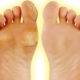 6 Ways To Get Rid Of Calluses On Feet Fast how-to-get-rid-of-calluses-on-feet-072e67ed6bd8096de197877ab34a43a35f0a63be