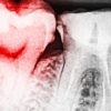 Are these regenerative tooth fillings the end of root canals forever? stem-cell-teeth-grow-c2ce73f8370021788f9dbb49774bbffc265caae5